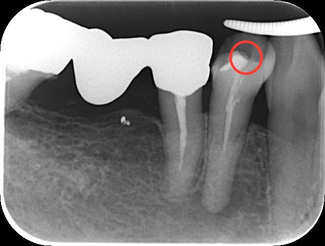 根管治療が失敗する原因 | 群馬県の歯内療法専門医院｜ひので歯科医院