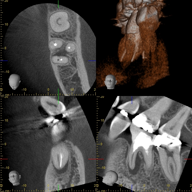 歯内療法（根の治療）のためのCBCT | 群馬県の歯内療法専門医院